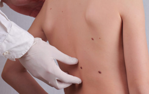 doctor-dermatologist-examines-child-patient-birthmark-close-up-mole-checkup-skin-tags-removal