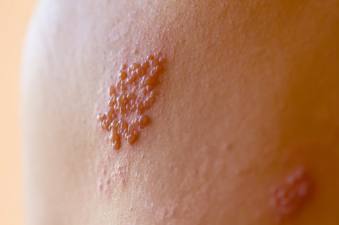 shingles-on-men-herpes-zoster-closeup