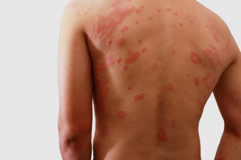 man-with-dermatitis-problem-of-rash-allergy-rash