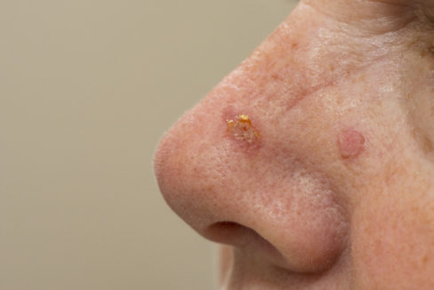 close-up-of-a-nose-that-has-been-treated-with-cryosurgery-for-sun-spots