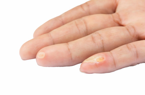 blisters-on-finger-caused-by-electric-shock