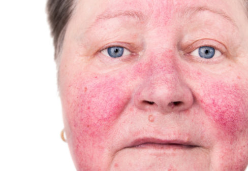 elderly-woman-with-rosacea-facial-skin-disorder-no-make-up