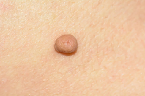 skin-tag-or-acrochondon-or-soft-fibroma-is-a-safe-it-have-not-effect-to-the-body-it-usually-occurs-at-neck-face-armpits-and-body