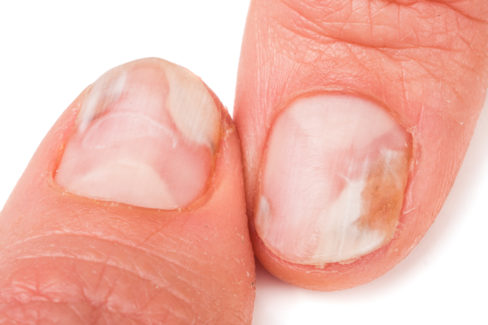 two-fingers-of-the-hand-with-a-fungus-on-the-nails-isolated-white-background