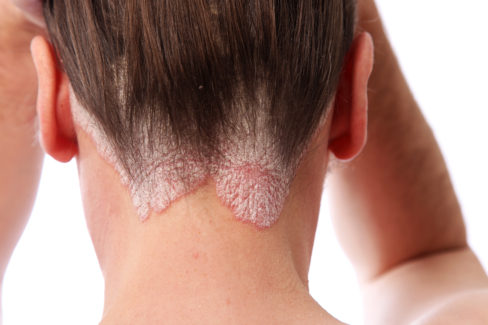 schuppenpflechte-psoriasis-am-haaransatz-und-auf-der-kopfhaut