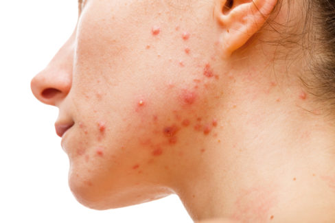 acne-skin
