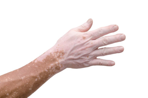 mans-hand-with-with-vitiligo-on-white-background