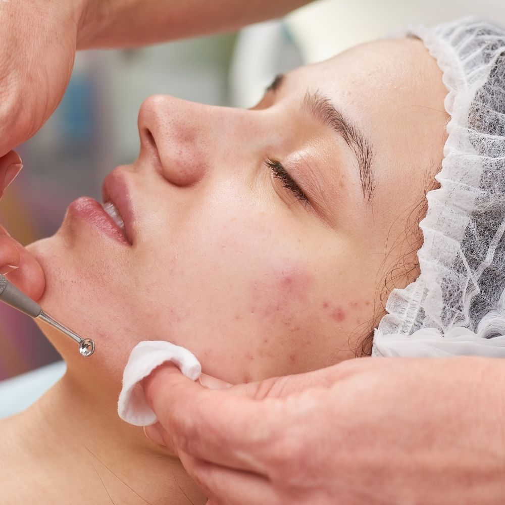 Acne Treatment Parma Ohio