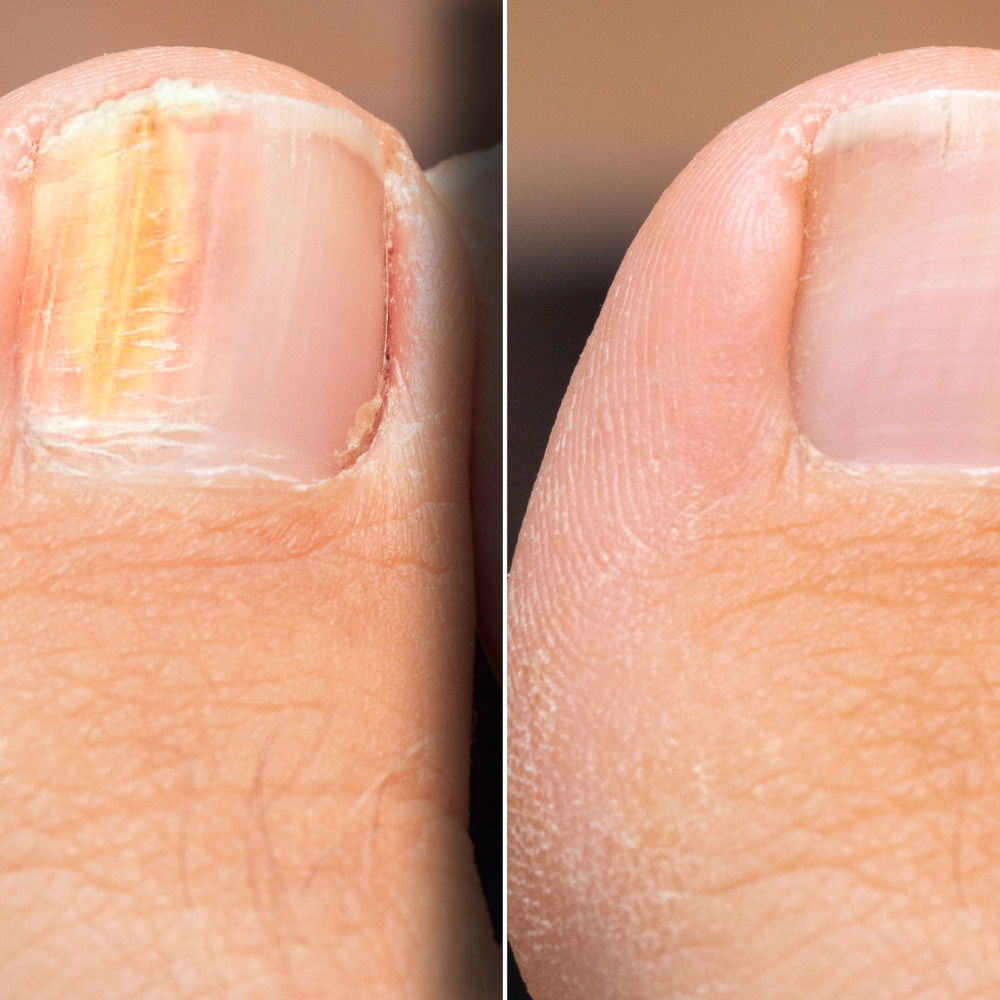 Fungal treatment parma ohio