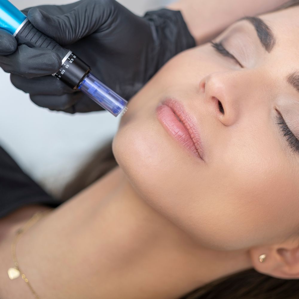 Micro Needling Parma Ohio