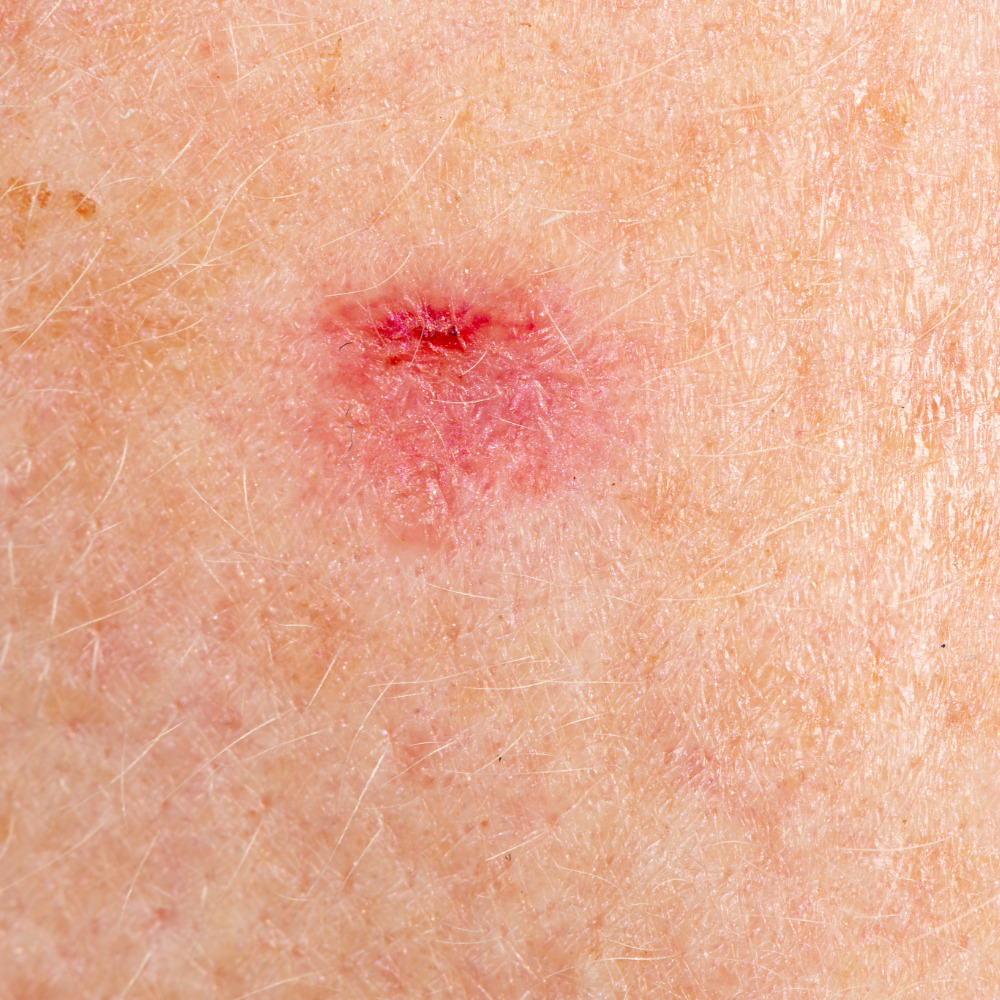 Pre-Cancerous Lesions parma ohio