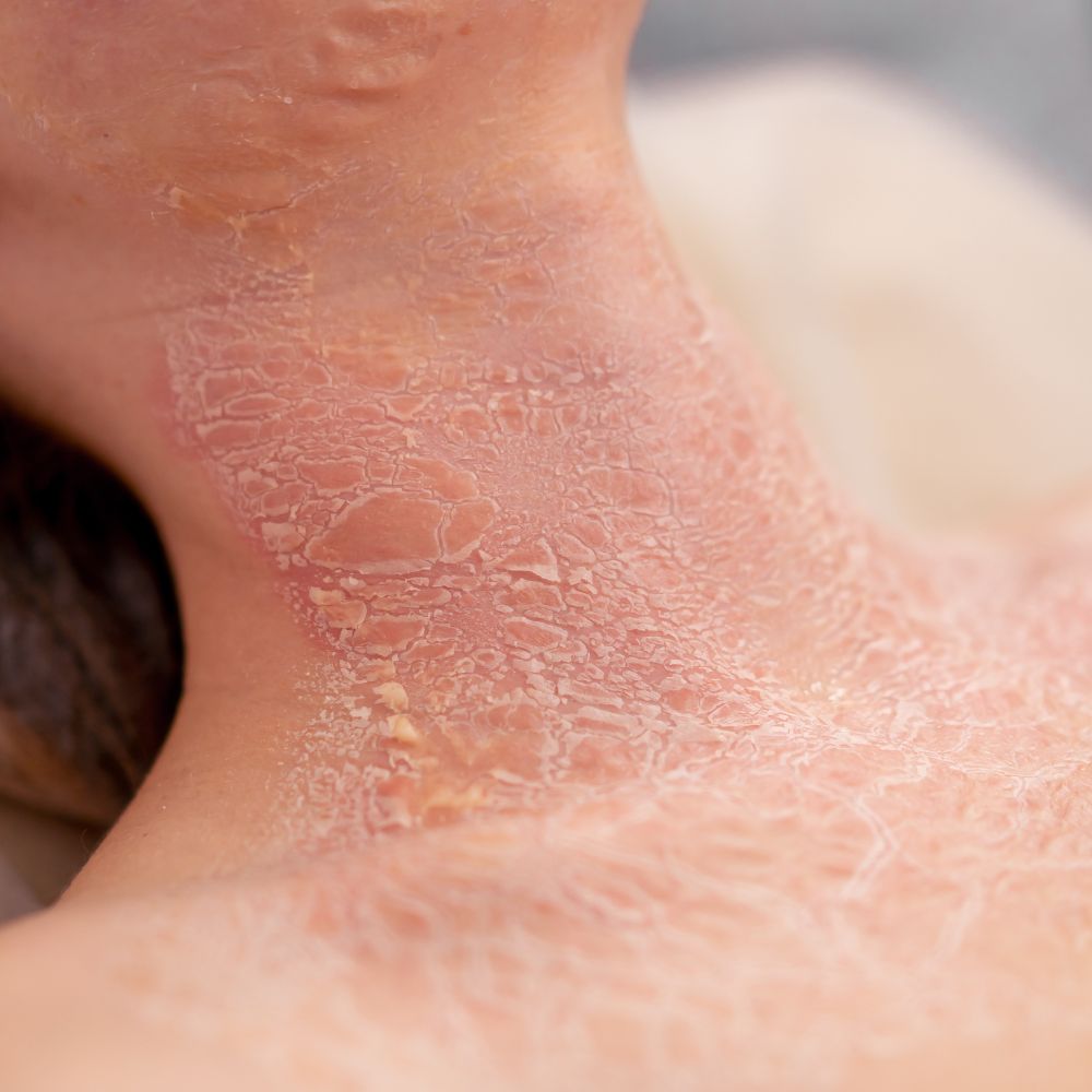 Psoriasis Treatment Parma Ohio