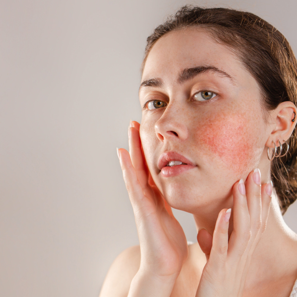 Rosacea treatment parma ohio