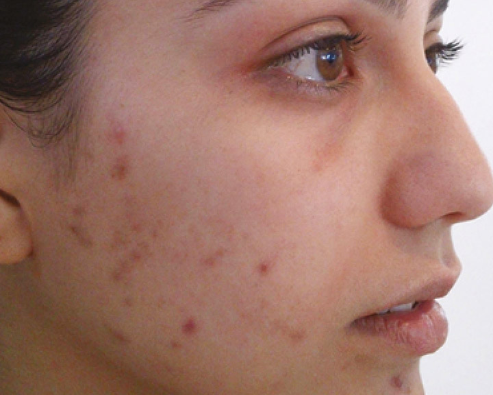 TPP-before-2-720x576