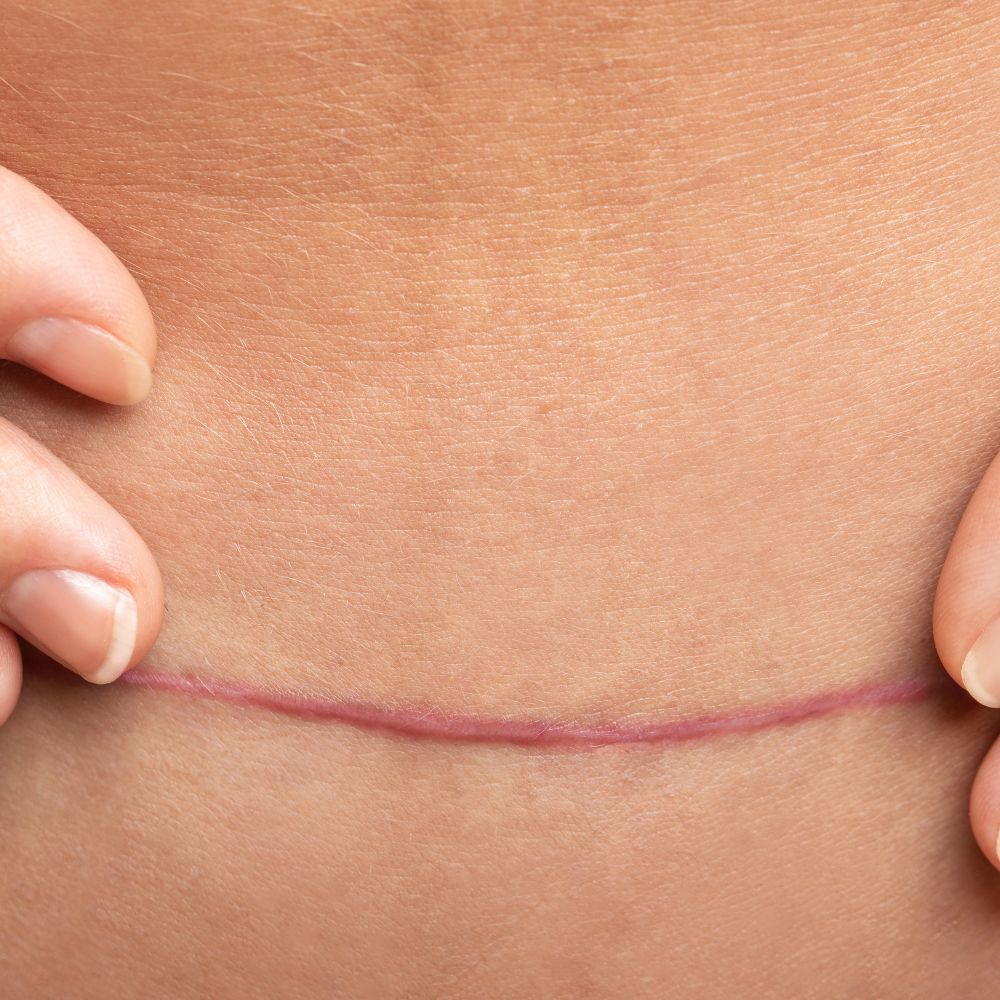 scar Treatment Parma Ohio