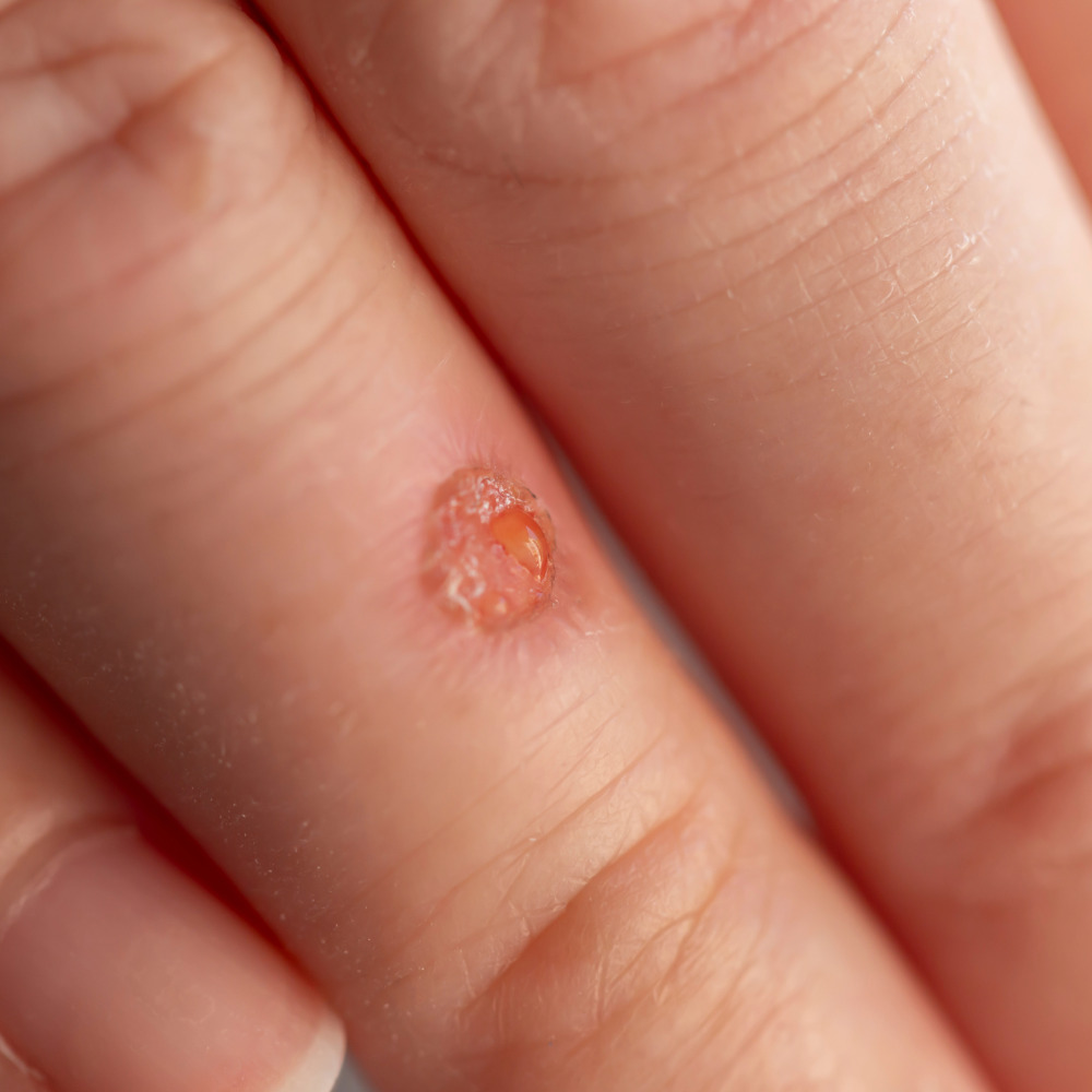 warts treatment parma ohio